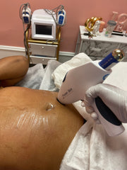 Exquis (Skin) Tightening